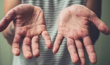 DSÖ'den maymun çiçeği uyarısı! Yakın temasa dikkat!