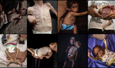 Gazze'de yetersiz beslenmeden ölen çocuklar insani krizin en acı yüzü oldu