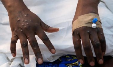 Gana'da M çiçeği virüsü vaka sayısında artış